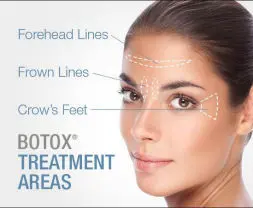 Botox Glasgow areas